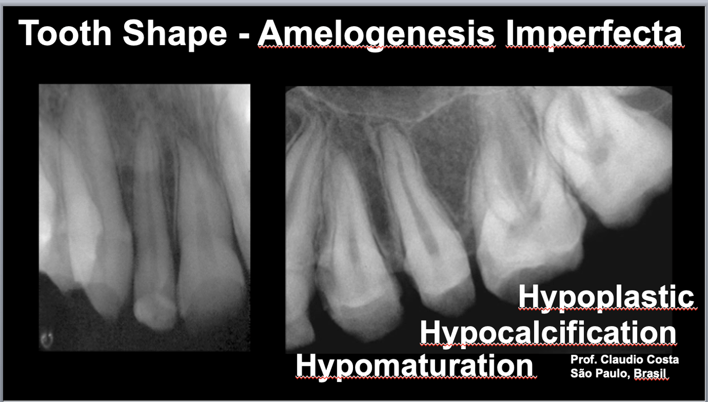 amelogenesis imperfecta radiograph